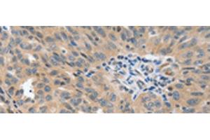 Immunohistochemistry of paraffin-embedded Human ovarian cancer tissue using P2RY6 Polyclonal Antibody at dilution of 1:40(x200) (P2RY6 抗体)
