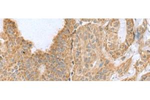 Immunohistochemistry of paraffin-embedded Human thyroid cancer tissue using CSRP2 Polyclonal Antibody at dilution of 1:60(x200) (CSRP2 抗体)