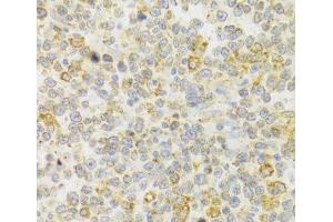 Immunohistochemistry of paraffin-embedded Human B cell lymphoma using KISS1R Polyclonal Antibody at dilution of 1:100 (40x lens). (KISS1R 抗体)