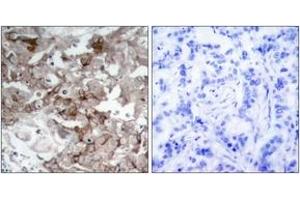 Immunohistochemistry analysis of paraffin-embedded human breast carcinoma tissue, using Cortactin (Ab-466) Antibody. (Cortactin 抗体  (AA 441-490))