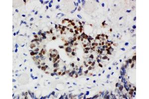 Anti-Nucleophosmin antibody, IHC(P) IHC(P): Human Intestinal Cancer Tissue (NPM1 抗体  (N-Term))