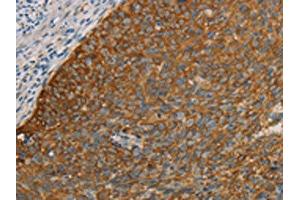 The image on the left is immunohistochemistry of paraffin-embedded Human cervical cancer tissue using ABIN7190690(FOXF2 Antibody) at dilution 1/30, on the right is treated with synthetic peptide. (FOXF2 抗体)