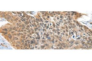 Immunohistochemistry of paraffin-embedded Human esophagus cancer tissue using BOLA1 Polyclonal Antibody at dilution of 1:35(x200) (BOLA1 抗体)