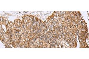 Immunohistochemistry of paraffin-embedded Human colorectal cancer tissue using HCCS Polyclonal Antibody at dilution of 1:110(x200) (HCCS 抗体)