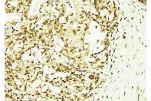 ABIN6273143 at 1/100 staining Human breast cancer tissue by IHC-P. (SSNA1 抗体  (N-Term))