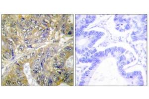 Immunohistochemistry analysis of paraffin-embedded human colon carcinoma tissue, using ES8L3 antibody. (EPS8-Like 3 抗体  (Internal Region))