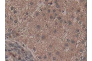 Detection of FMOD in Human Liver cancer Tissue using Polyclonal Antibody to Fibromodulin (FMOD)