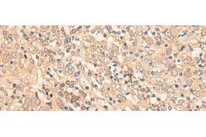 Immunohistochemistry of paraffin-embedded Human cervical cancer tissue using EIF2B5 Polyclonal Antibody at dilution of 1:25(x200) (EIF2B5 抗体)