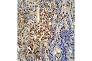 Formalin fixed, paraffin embedded human lung carcinoma stained with PUS3 Antibody (N-term) followed by peroxidase conjugation of the secondary antibody and DAB staining. (PUS3 抗体  (N-Term))