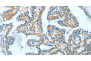 Immunohistochemistry of paraffin-embedded Human thyroid cancer tissue using ASCC1 Polyclonal Antibody at dilution 1:50 (ASCC1 抗体)