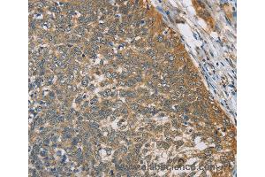 Immunohistochemistry of Human thyroid cancer using TNFRSF10D Polyclonal Antibody at dilution of 1:40 (DcR2 抗体)