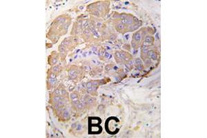 Formalin-fixed and paraffin-embedded human breast carcinoma tissue reacted with HSPB1 polyclonal antibody  , which was peroxidase-conjugated to the secondary antibody, followed by DAB staining. (HSP27 抗体  (Ser82))