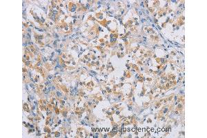 Immunohistochemistry of Human gastric cancer using CERKL Polyclonal Antibody at dilution of 1:50 (CERKL 抗体)