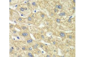 Immunohistochemistry of paraffin-embedded Human liver damage using DLD Polyclonal Antibody at dilution of 1:100 (40x lens). (DLD 抗体)