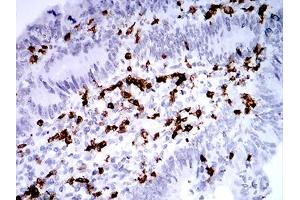 Immunohistochemical analysis of paraffin-embedded rectum cancer tissues using CD2 mouse mAb with DAB staining. (CD2 抗体  (AA 25-140))
