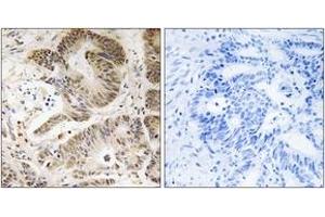 Immunohistochemistry analysis of paraffin-embedded human colon carcinoma tissue, using PIK3R5 Antibody. (PIK3R5 抗体  (AA 695-744))