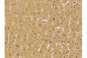 ZFX Mouse Monoclonal Antibody at 1/100 staining human liver cancer by IHC-P.