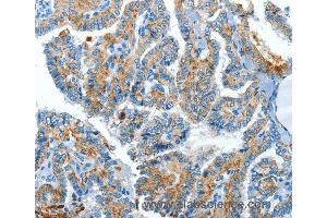 Immunohistochemistry of Human esophagus cancer using CLPTM1L Polyclonal Antibody at dilution of 1:60 (CLPTM1L 抗体)