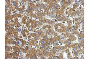 IHC-P Image Immunohistochemical analysis of paraffin-embedded human hepatoma, using alpha-1-Microglobulin, antibody at 1:500 dilution. (AMBP 抗体)