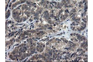 Immunohistochemical staining of paraffin-embedded Adenocarcinoma of Human ovary tissue using anti-DOK7 mouse monoclonal antibody. (DOK7 抗体)