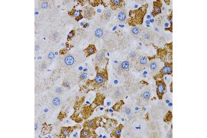 Immunohistochemistry of paraffin-embedded human liver cancer using CYP24 antibody (805) at dilution of 1:200 (40x lens). (CYP24A1 抗体  (AA 36-448))