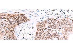 Immunohistochemistry of paraffin-embedded Human esophagus cancer tissue using IRF2BP1 Polyclonal Antibody at dilution of 1:40(x200) (IRF2BP1 抗体)