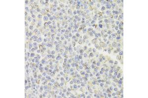 Immunohistochemistry of paraffin-embedded human B cell lymphoma using CD74 Antibody (ABIN5973310) at dilution of 1/100 (40x lens). (CD74 抗体)