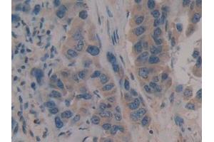 Detection of CD109 in Human Breast cancer Tissue using Polyclonal Antibody to Cluster Of Differentiation 109 (CD109) (CD109 抗体  (AA 1146-1390))