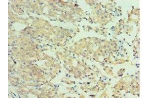 Immunohistochemistry of paraffin-embedded human colon cancer using ABIN7160651 at dilution of 1:100 (MTMR4 抗体  (AA 570-820))