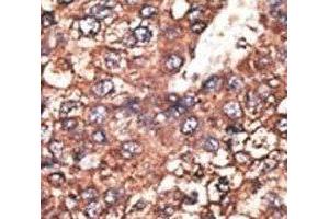 IHC analysis of FFPE human hepatocarcinoma tissue stained with the Leptin Receptor antibody (Leptin Receptor 抗体  (AA 23-52))
