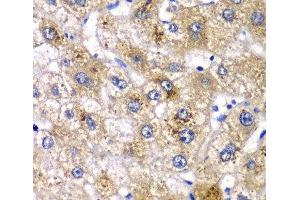 Immunohistochemistry of paraffin-embedded Human liver damage using AMY2A Polyclonal Antibody at dilution of 1:100 (40x lens). (AMY2A 抗体)