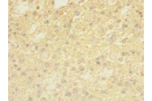 Immunohistochemistry of paraffin-embedded human glioma using ABIN7173241 at dilution of 1:100 (TMEM56 抗体  (AA 232-263))