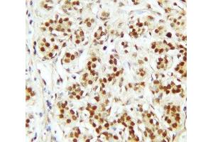 IHC-P: CTBP2 antibody testing of human breast cancer tissue (CTBP2 抗体  (C-Term))