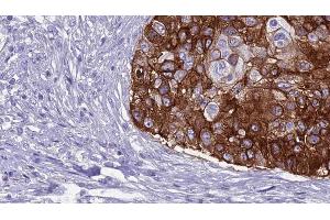 ABIN6269007 at 1/100 staining Human urothelial cancer tissue by IHC-P. (GRM8 抗体  (C-Term))