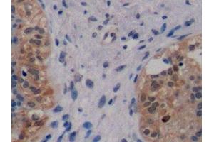 Detection of ErbB2 in Human Breast cancer Tissue using Monoclonal Antibody to Receptor Tyrosine Protein Kinase erbB-2 (ErbB2) (ErbB2/Her2 抗体  (AA 376-578))