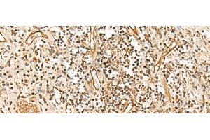 Immunohistochemistry of paraffin-embedded Human prost ate cancer tissue using HUS1 Polyclonal Antibody at dilution of 1:65(x200) (HUS1 抗体)