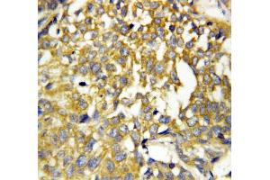 Anti-Pleiotrophin antibody, IHC(P) IHC(P): Human Mammary Cancer Tissue (Pleiotrophin 抗体  (C-Term))
