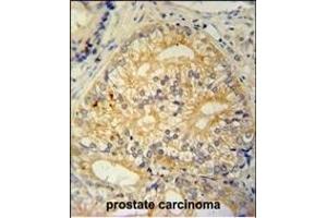 C antibody (N-term) (ABIN654965 and ABIN2844604) immunohistochemistry analysis in formalin fixed and paraffin embedded human prostate carcinoma followed by peroxidase conjugation of the secondary antibody and DAB staining. (C16ORF13 抗体  (N-Term))