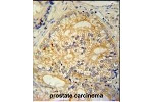 C antibody (N-term) (ABIN654965 and ABIN2844604) immunohistochemistry analysis in formalin fixed and paraffin embedded human prostate carcinoma followed by peroxidase conjugation of the secondary antibody and DAB staining. (C16ORF13 抗体  (N-Term))