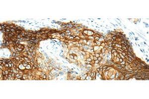 Immunohistochemistry of paraffin-embedded Human cervical cancer using AQP3 Polyclonal Antibody at dilution of 1/30 (AQP3 抗体)
