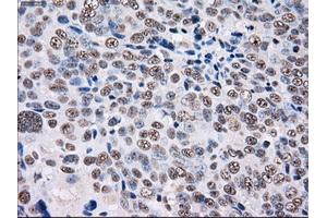 Immunohistochemical staining of paraffin-embedded Adenocarcinoma of colon tissue using anti-PSMD10mouse monoclonal antibody. (PSMD10 抗体)