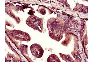 Immunohistochemistry of paraffin-embedded human prostate tissue using ABIN7169055 at dilution of 1:100 (UHMK1 抗体  (AA 183-385))