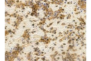 ABIN6265801 and ABIN6266839 at 1/100 staining human melanoma by IHC-P.