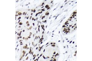 Immunohistochemistry of paraffin-embedded human esophageal cancer using A Rabbit mAb (ABIN7265699) at dilution of 1:100 (40x lens).