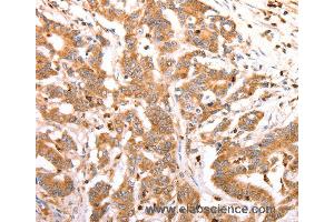 Immunohistochemistry of Human lung cancer using CELSR2 Polyclonal Antibody at dilution of 1:50 (CELSR2 抗体)