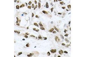 Immunohistochemical analysis of MCM6 staining in human lung cancer formalin fixed paraffin embedded tissue section. (MCM6 抗体)