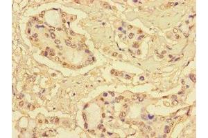 Immunohistochemistry of paraffin-embedded human pancreatic cancer using ABIN7166091 at dilution of 1:100 (MBTPS1 抗体  (AA 17-70))