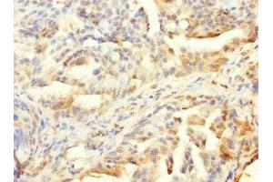 Immunohistochemistry of paraffin-embedded human lung cancer using ABIN7155913 at dilution of 1:100 (HCFC1R1 抗体  (AA 1-119))