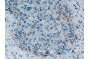 IHC-P analysis of Human Liver CancerTissue, with DAB staining. (SMAD5 抗体  (AA 210-464))