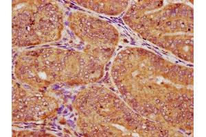 IHC image of ABIN7146866 diluted at 1:150 and staining in paraffin-embedded human endometrial cancer performed on a Leica BondTM system.